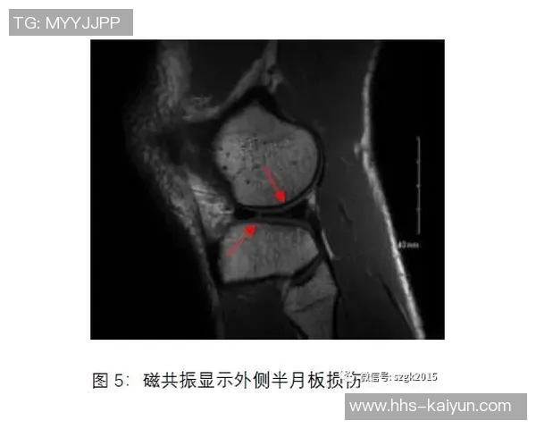 加维已顺利完成半月板手术,康复训练正式启动,期待新赛季回归赛场 加维已顺利完成半月板手术,康复训练正式启动,期待新赛季回归赛场